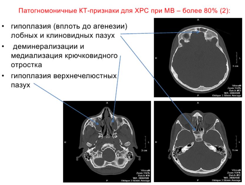 Полипозный риносинусит кт картина