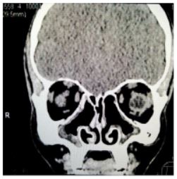 pari-sinus-91