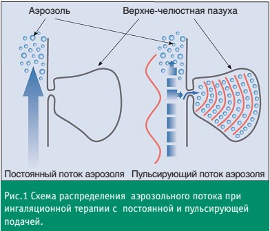 лечение риносинусита